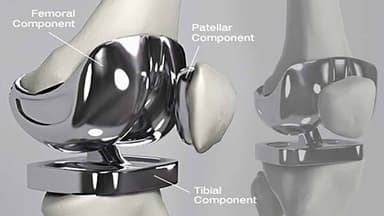 Giúp bạn nắm rõ thay khớp gối có nguy hiểm không