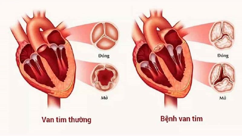 Hẹp van tim chủ yếu xảy ra với van 2 lá và van động mạch chủ.