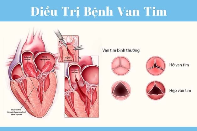 Bệnh về van tim xảy ra khi một hoặc nhiều van tim không thực hiện tốt chức năng đóng mở giúp máu lưu thông theo một chiều.