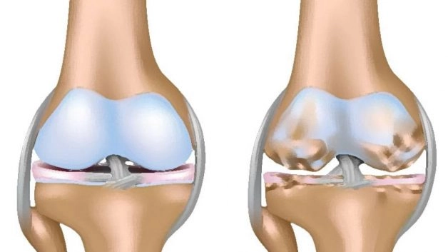 Khô dịch khớp và những ảnh hưởng của bệnh