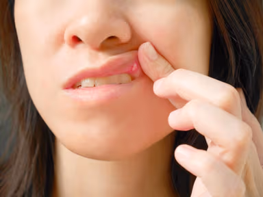 Nhiệt miệng phải làm sao? Cách điều trị hiệu quả nhất