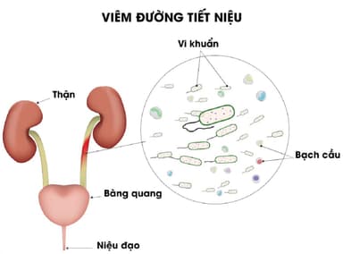 Viêm đường tiết niệu tiểu ra máu có nguy hiểm không?