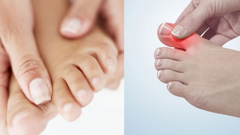 Viêm khớp ngón chân: Dấu hiệu nhận biết sớm