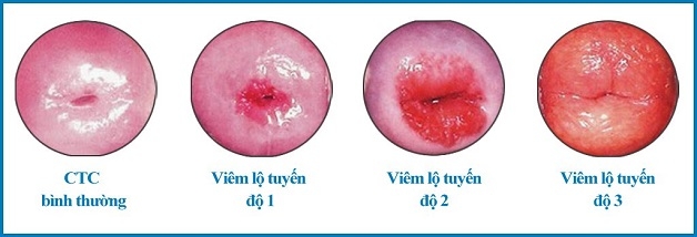 viêm lộ tuyến cổ tử cung có nên đốt không