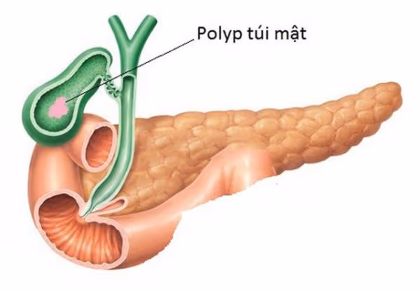 Phát hiện có polyp túi mật