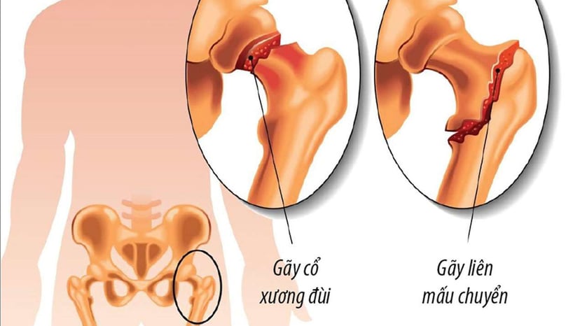 Bệnh nhân sau khi thay khớp háng bao lâu thì đi được?