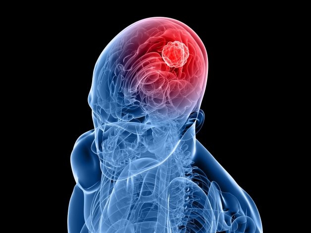 Các cách điều trị ung thư não phổ biến