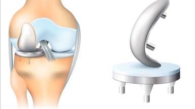 Chi phí phẫu thuật thay khớp gối bao nhiêu tiền?