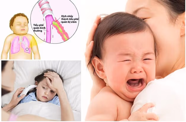 Có nhiều nguyên nhân gây ra tình trạng viêm phế quản ở trẻ