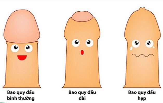 Khi bị dài hẹp bao quy đầu thì nên thực hiện thủ thuật cắt bao quy đầu