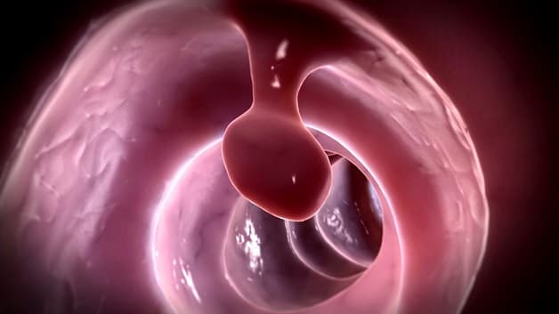 Hình ảnh polyp đại trực tràng