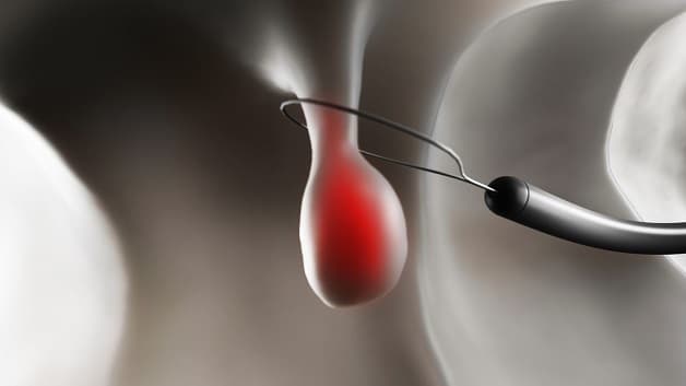 Cắt polyp đại trực tràng