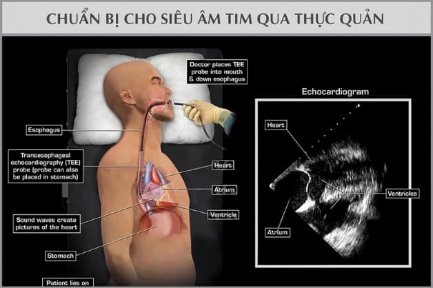 Trong siêu âm về tim qua thực quản, người bệnh phải nuốt một đầu dò có gắn sợi dây cáp quang mỏng có kết nối với máy siêu âm.