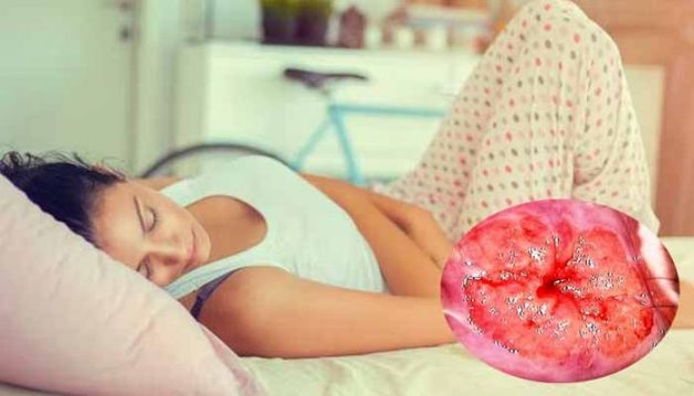 Viêm lộ tuyến cổ tử cung diện rộng là căn bệnh nhiều chị em gặp phải