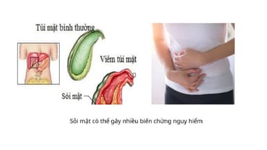 Viêm túi mật triệu chứng là gì – cách điều trị hiệu quả
