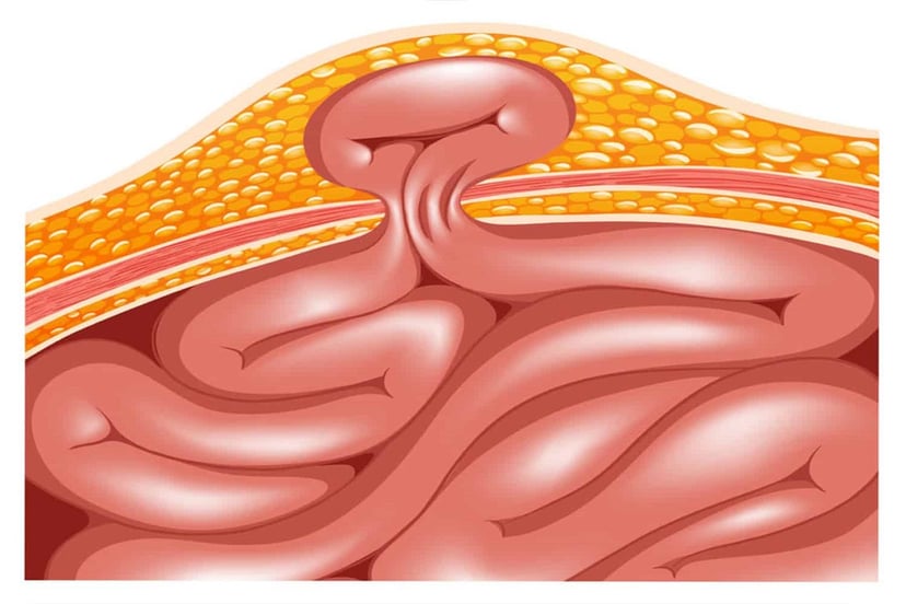 Xem ngay các dấu hiệu thoát vị bẹn thường gặp