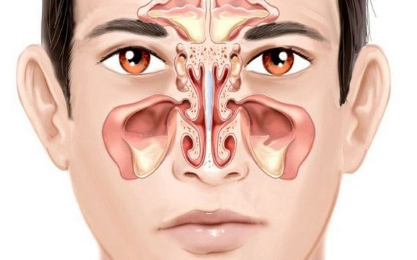 Cấu tạo xương mũi có thể là một trong những nguyên nhân dẫn tới bệnh viêm đa xoang