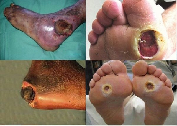 biến chứng bàn chân do tiểu đường gây ra