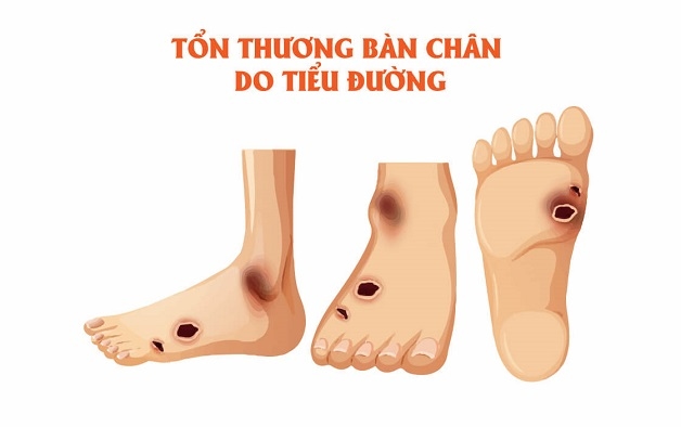 các biến chứng đái tháo đường làm tăng nguy cơ cắt cụt chi