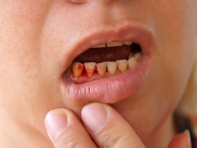 Dấu hiệu ung thư máu ở trẻ em - chảy máu nướu