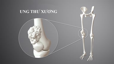 Giải đáp thắc mắc: Ung thư xương có chữa được không?