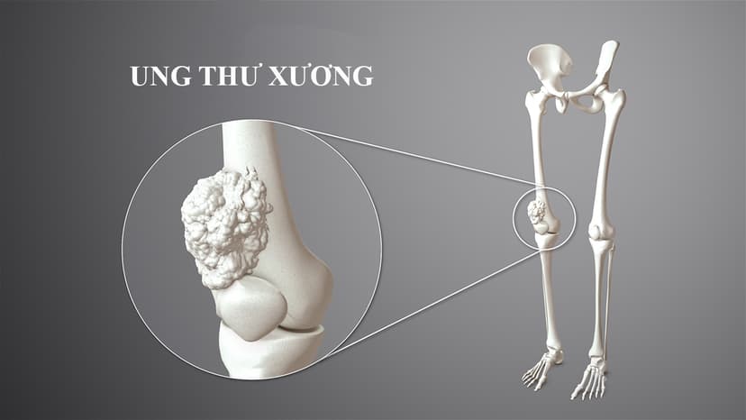 Giải đáp thắc mắc: Ung thư xương có chữa được không?