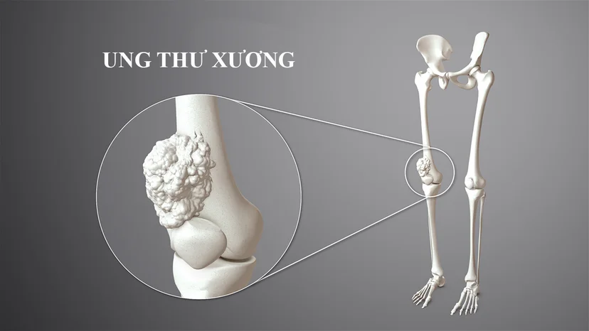 Giải đáp thắc mắc: Ung thư xương có chữa được không?