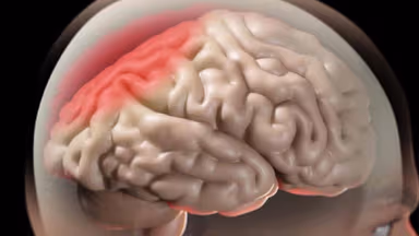 Hay bị đau nửa đầu coi chừng một số bệnh lý trong não