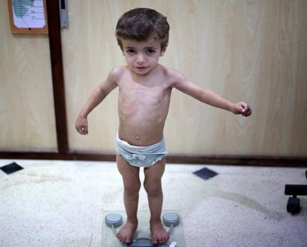 Trẻ em suy dinh dưỡng khiến nhiều bậc phụ huynh lo lắng. Suy dinh dưỡng gây ra tình trạng thiếu hụt các chất dinh dưỡng cần thiết của cơ thể trẻ và làm ảnh hưởng đến quá trình sống, hoạt động và tăng trưởng bình thường của trẻ.