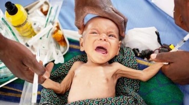 Suy dinh dưỡng ở trẻ nhỏ có thể xảy ra do tình trạng thiếu cung cấp, tăng tiêu hao dưỡng chất hoặc cả hai.