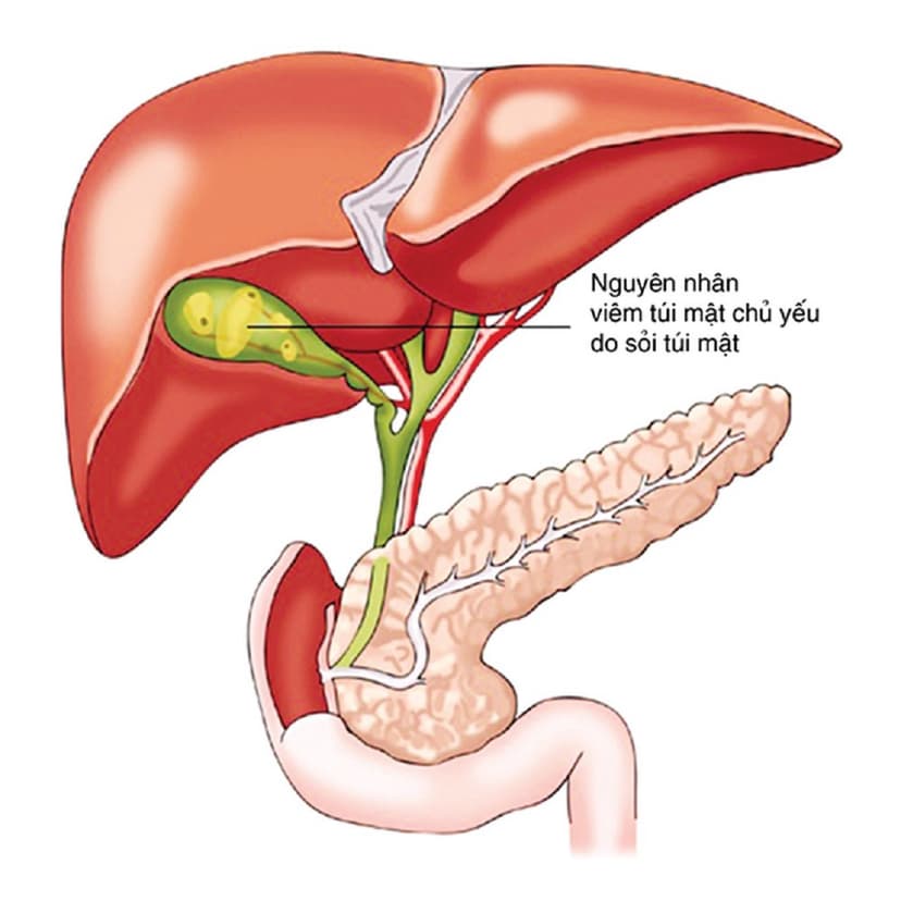 Viêm túi mật điều trị như thế nào?