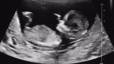 Siêu âm sàng lọc tuần 12 có thực sự cần thiết?