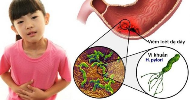 Bé bị đau dạ dày khi vi khuẩn Helicobacter Pylori tấn công và xâm nhập