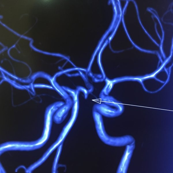 dị dạng mạch máu não, phình động mạch não dễ dẫn tới xuất huyết não (vỡ mạch máu não)