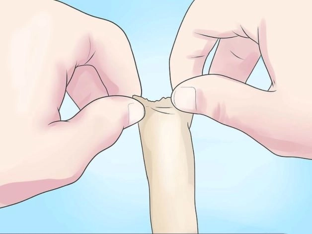 Cách tuột bao quy đầu tại nhà như thế nào cho đúng cách, an toàn, tránh nguy cơ lây nhiễm là mối quan tâm của nhiều cánh mày râu khi bị bệnh hẹp bao quy đầu.