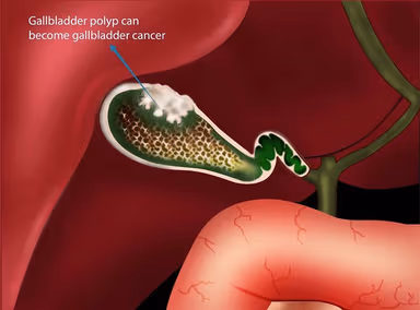 Hướng dẫn cách xử lý khi bị polyp túi mật