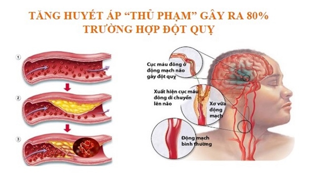 tăng huyết áp là một trong những nguyên nhân gây tai biến mạch máu não