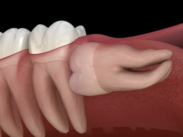 Răng mọc ngầm là răng nằm sâu bên trong xương hàm hoặc ngay dưới nướu