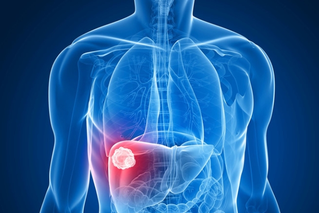 triệu chứng ung thư gan