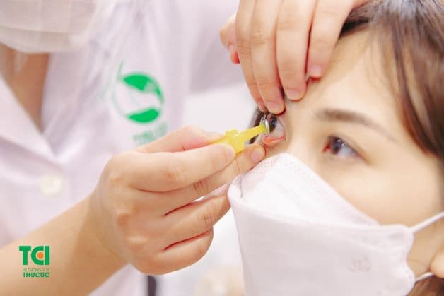 Ortho K hay còn có tên gọi đầy đủ là Orthokeratology (Kính cứng thấm khí chỉnh hình giác mạc). Đây là một thấu kính cứng được đeo vào mắt nhằm điều chỉnh tật khúc xạ trong khi ngủ (từ 6 – 8h mỗi ngày).