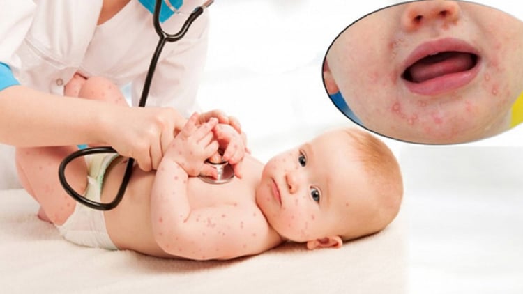 Bệnh tay chân miệng có thể tái phát.