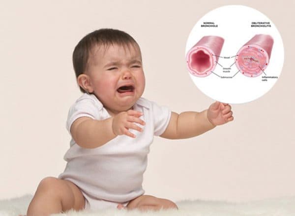Viêm tiểu phế quản ở trẻ em là bệnh lý nhiễm virus của đường hô hấp gây viêm và tắc nghẽn trong tiểu phế quản của phổi