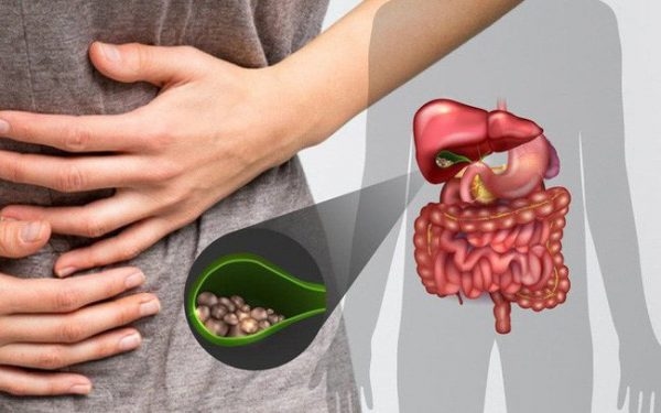 Bị sỏi túi mật có thể gây ung thư túi mật
