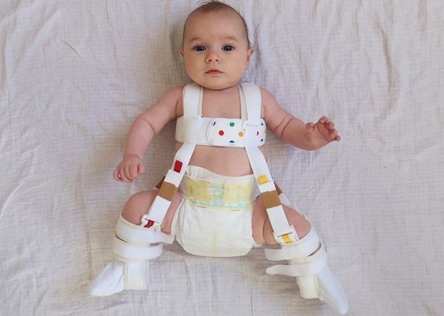 siêu âm khớp háng ở trẻ nhỏ