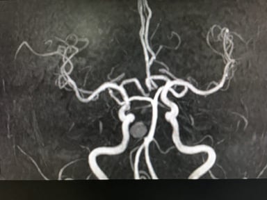 Bệnh mạch máu não và cách xử trí