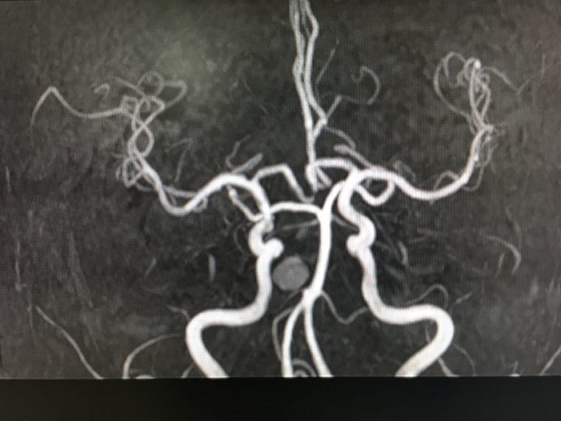 bệnh mạch máu não