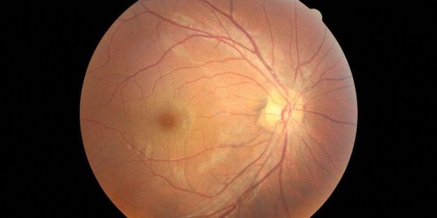 Hắc võng mạc trung tâm thanh dịch là căn bệnh lành tính