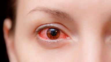 Làm thế nào có thể điều trị viêm kết mạc dị ứng?