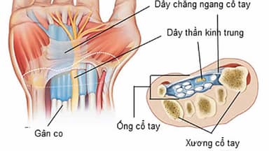 Siêu âm khớp cổ tay giúp phát hiện bệnh lý nào?
