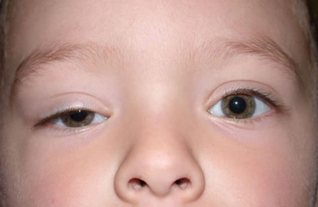 Sụp mí bẩm sinh là căn bệnh thường gặp ở trẻ em